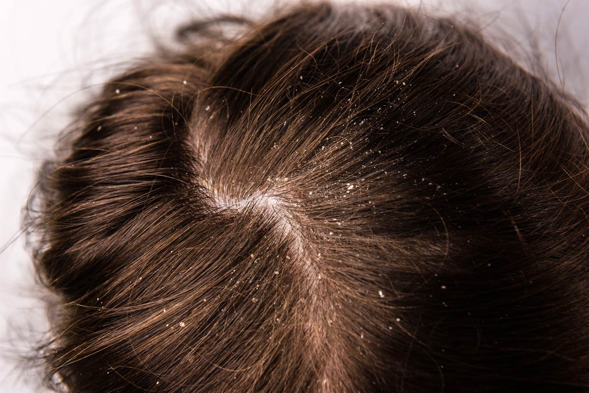 different types of dandruff and home remedies