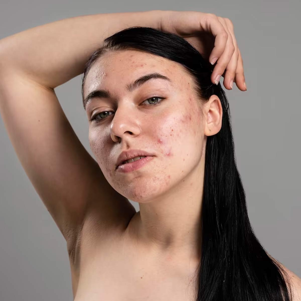 how to use aloe vera gel for acne marks