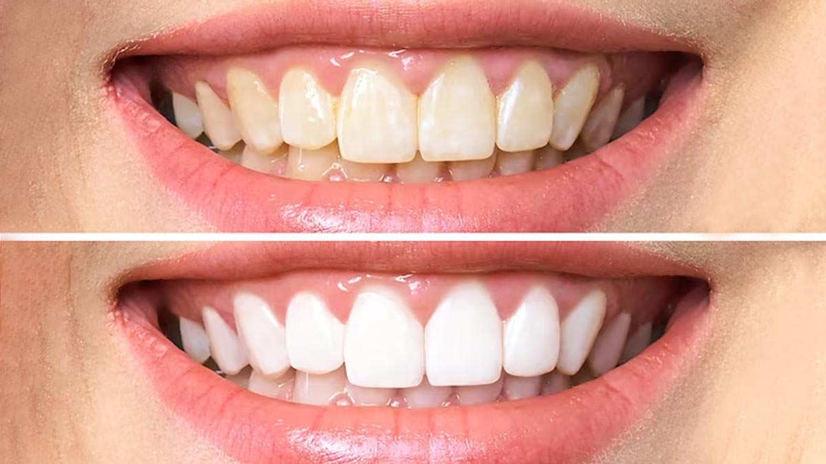 Teeth Whitening Home Remedy பற்கள் வெள்ளையாக, மஞ்சள் கறை நீங்க