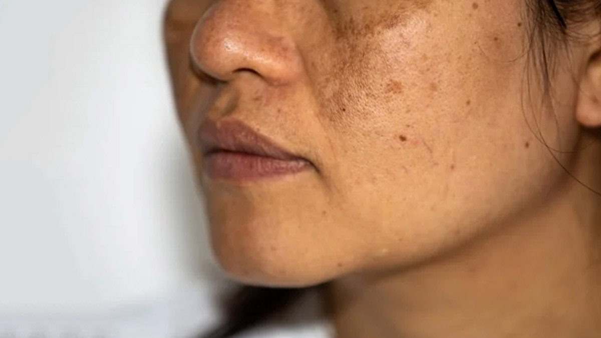 बदलते मौसम में पिगमेंटेशन की समस्या कम करने के उपाय | tips for  hyperpigmentation during changing weather | HerZindagi