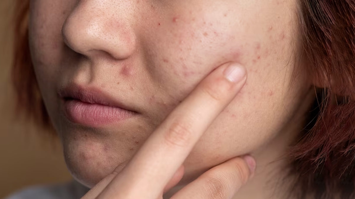 can milk be a cause of your acne problem