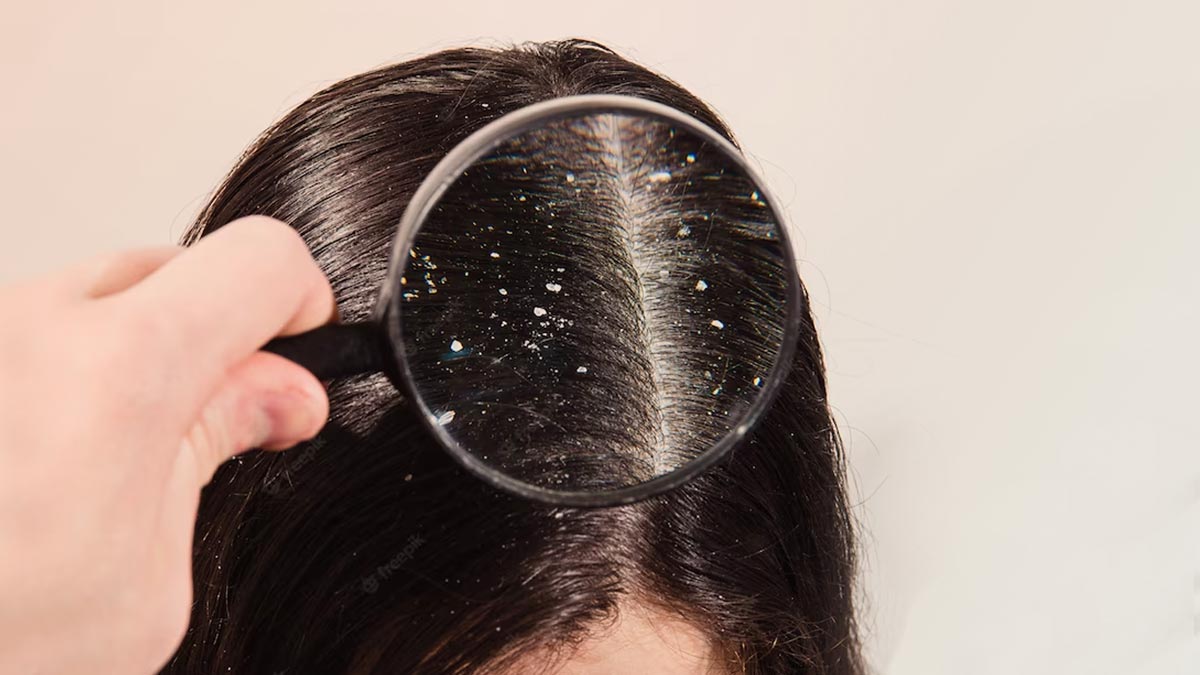 homemade hair mask for dandruff problem