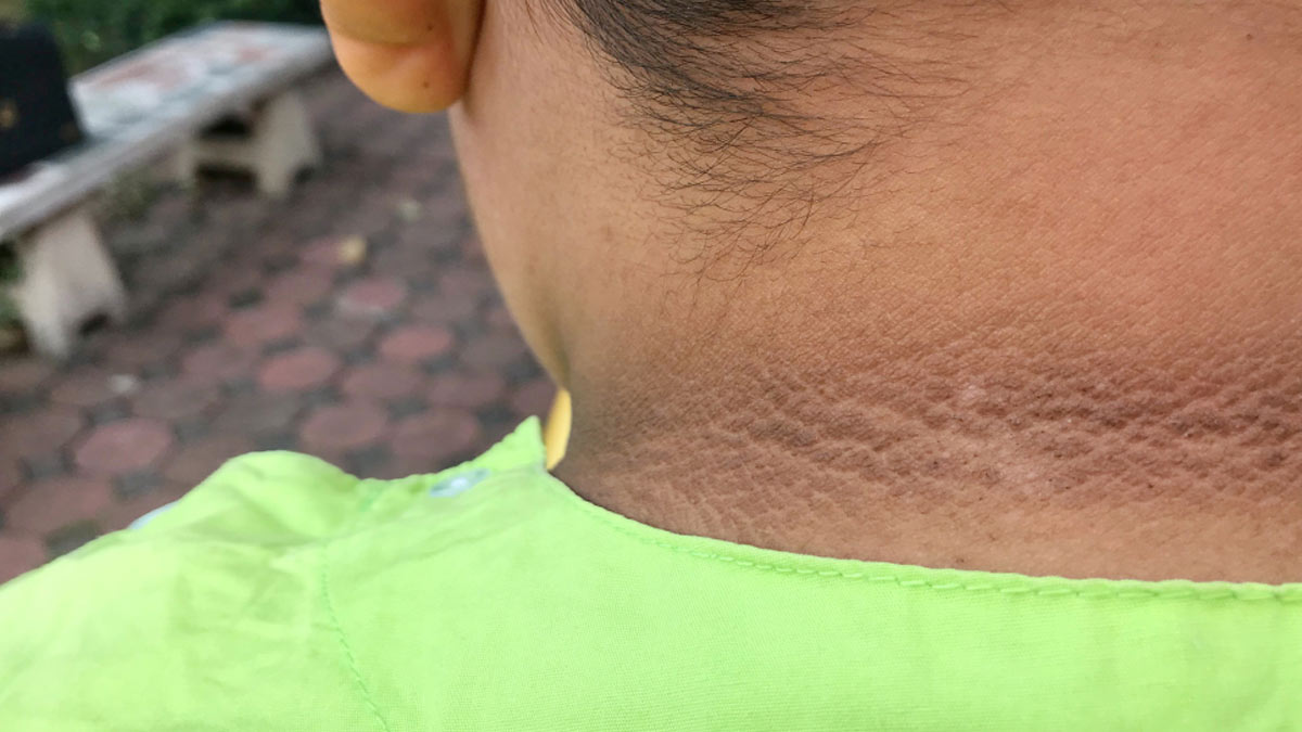 how diabetes impact your neck hindi