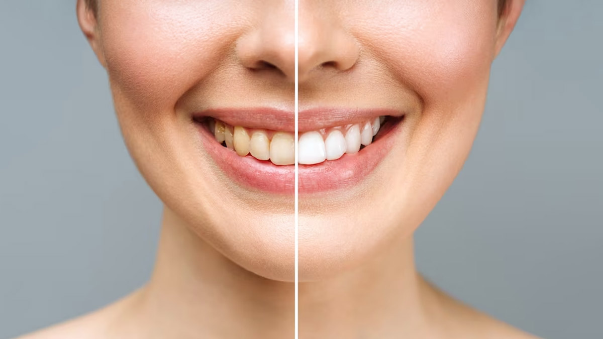 how to get white teeth and healthy oral cavity