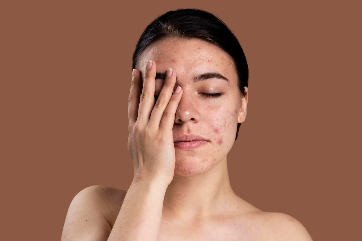 lactic acid for fine lines