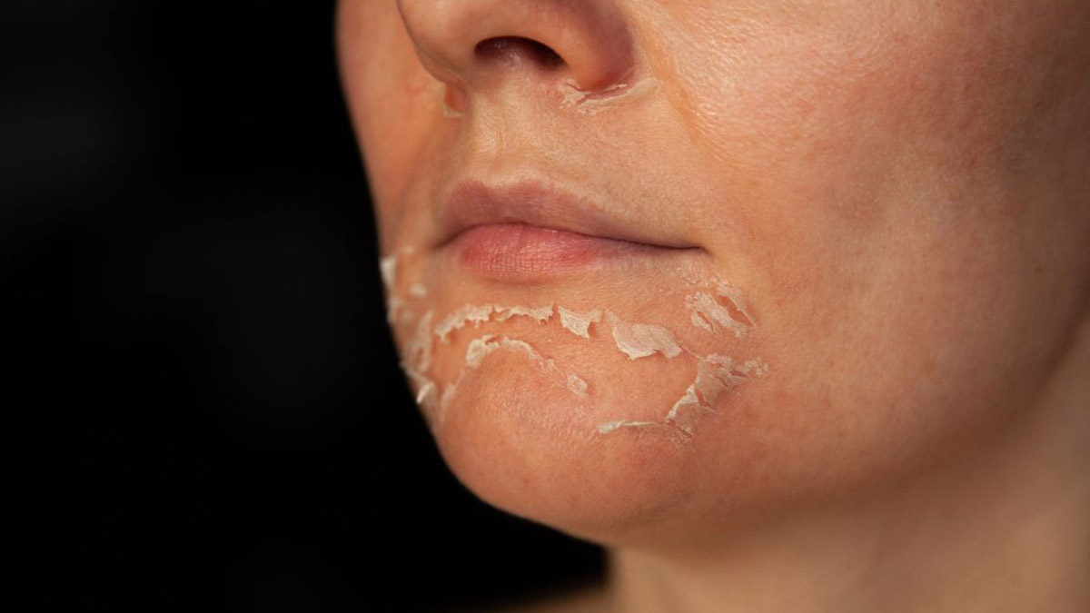 peeling skin problem