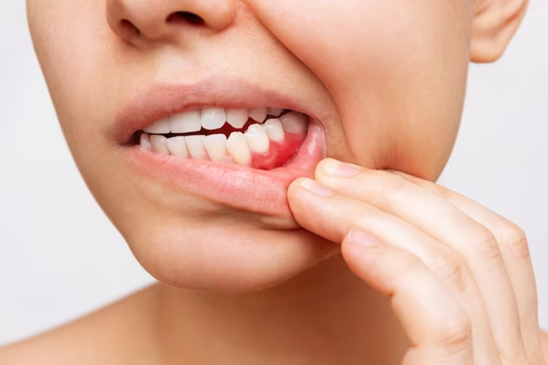 gum bleeding reasons