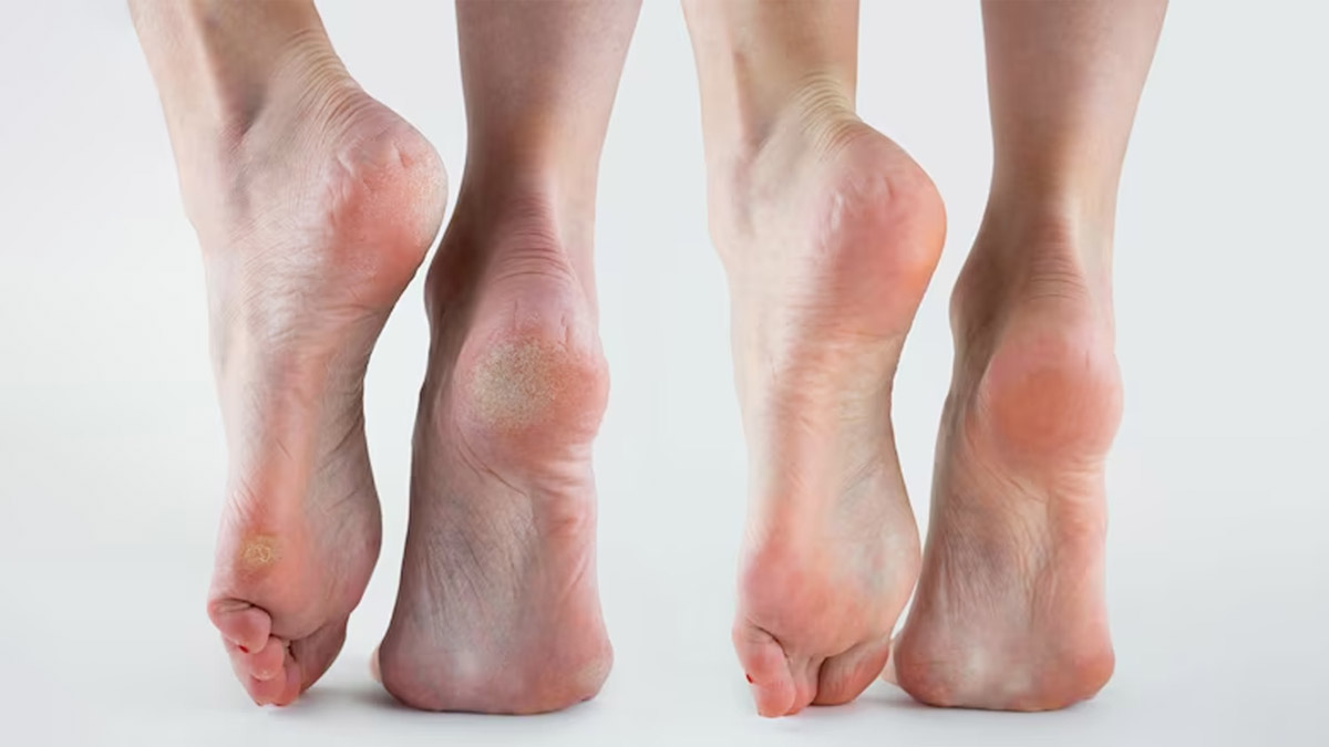 mustard oil remedies for cracked feet