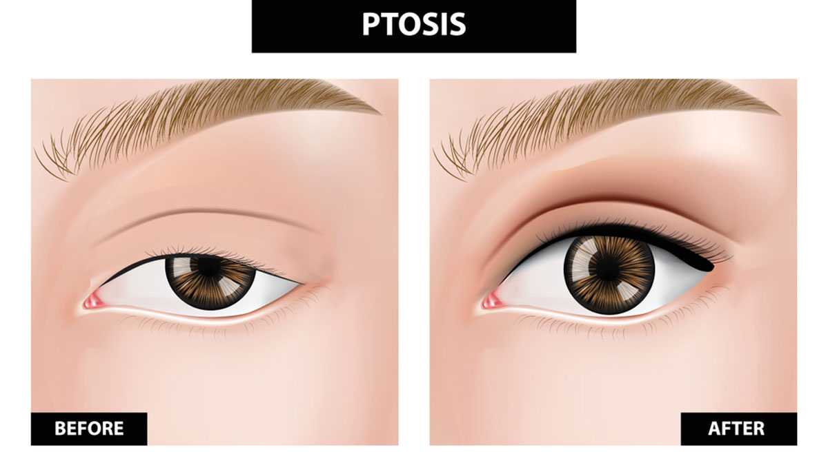 Ptosis