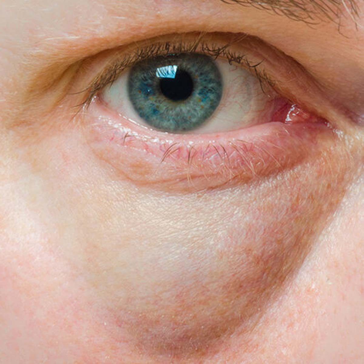 causes of puffy eyes