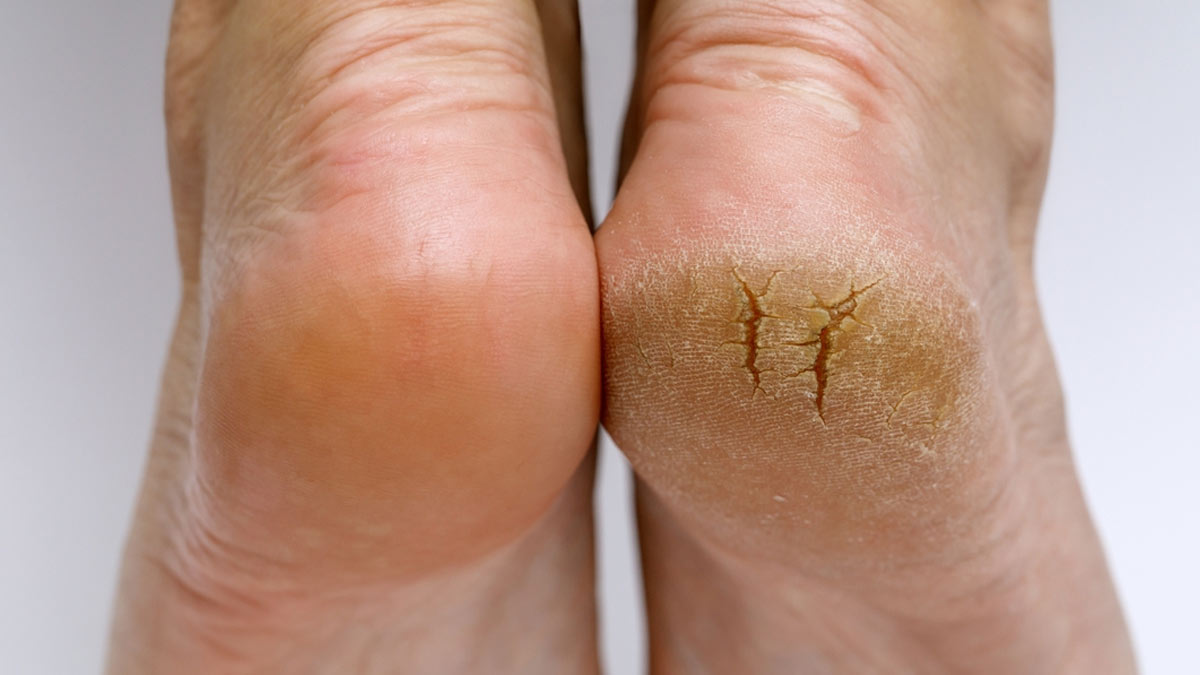 Itching of the Feet: 9 Common Causes