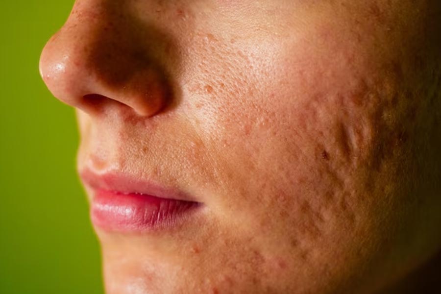 how to get rid of pores on face