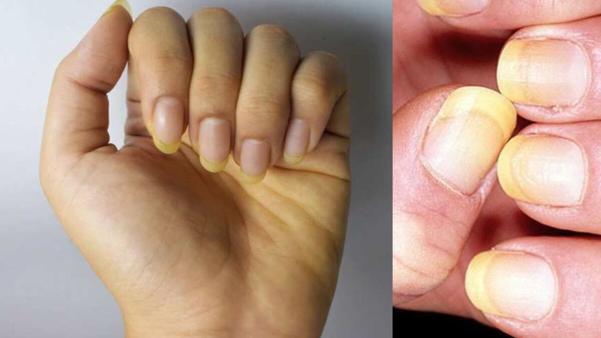 Yellow Nails Causes: इन कारणों से होते हैं पीले नाखून