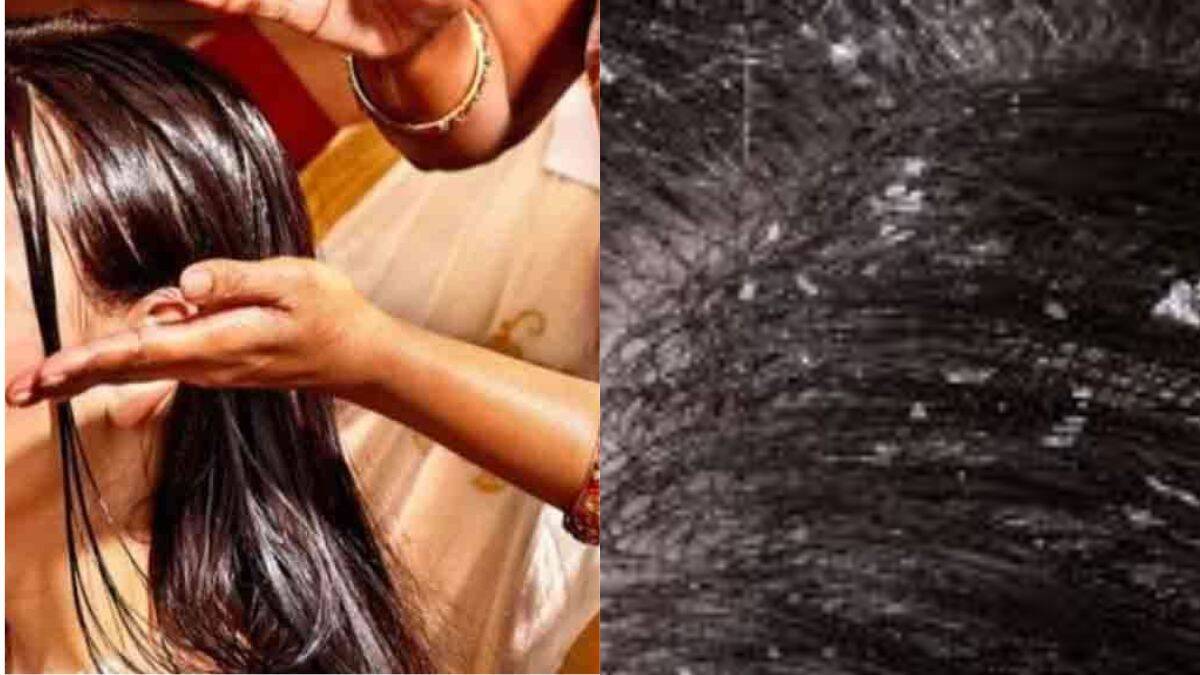 Remove Dandruff : குளிர்காலத்தில் பொடுகு பிரச்சினையா ? கற்றாழையை பயன்படுத்தி கவலையை தீர்த்திடுங்கள்