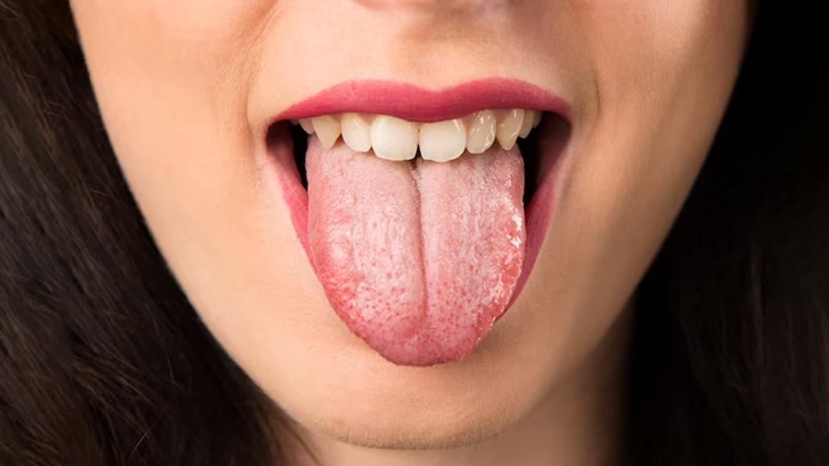 white tongue treatment