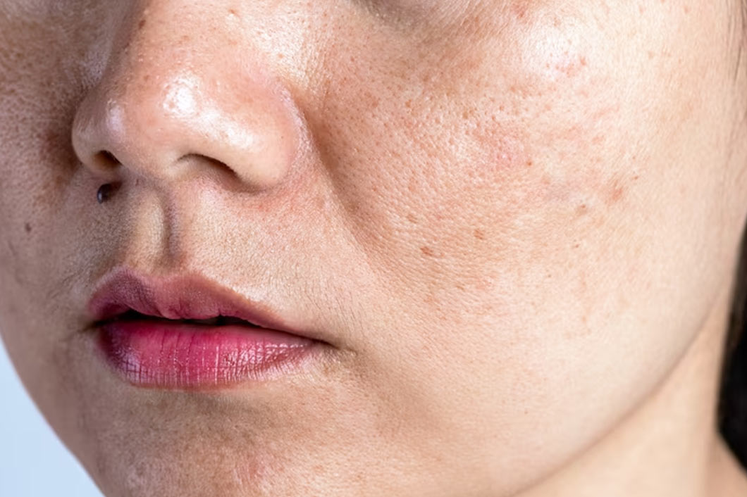 how to use besan for pigmentation problem