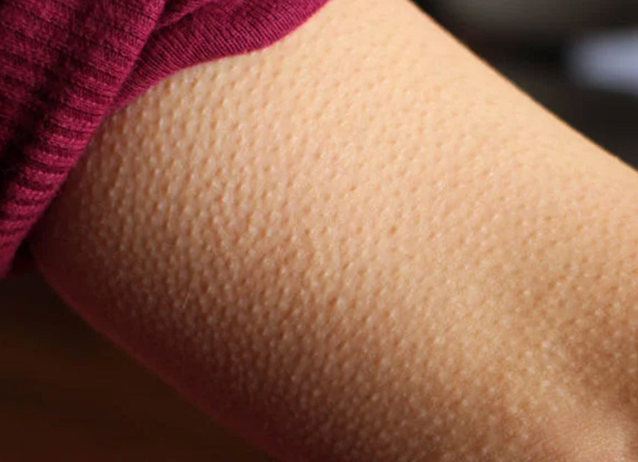 what are goosebumps