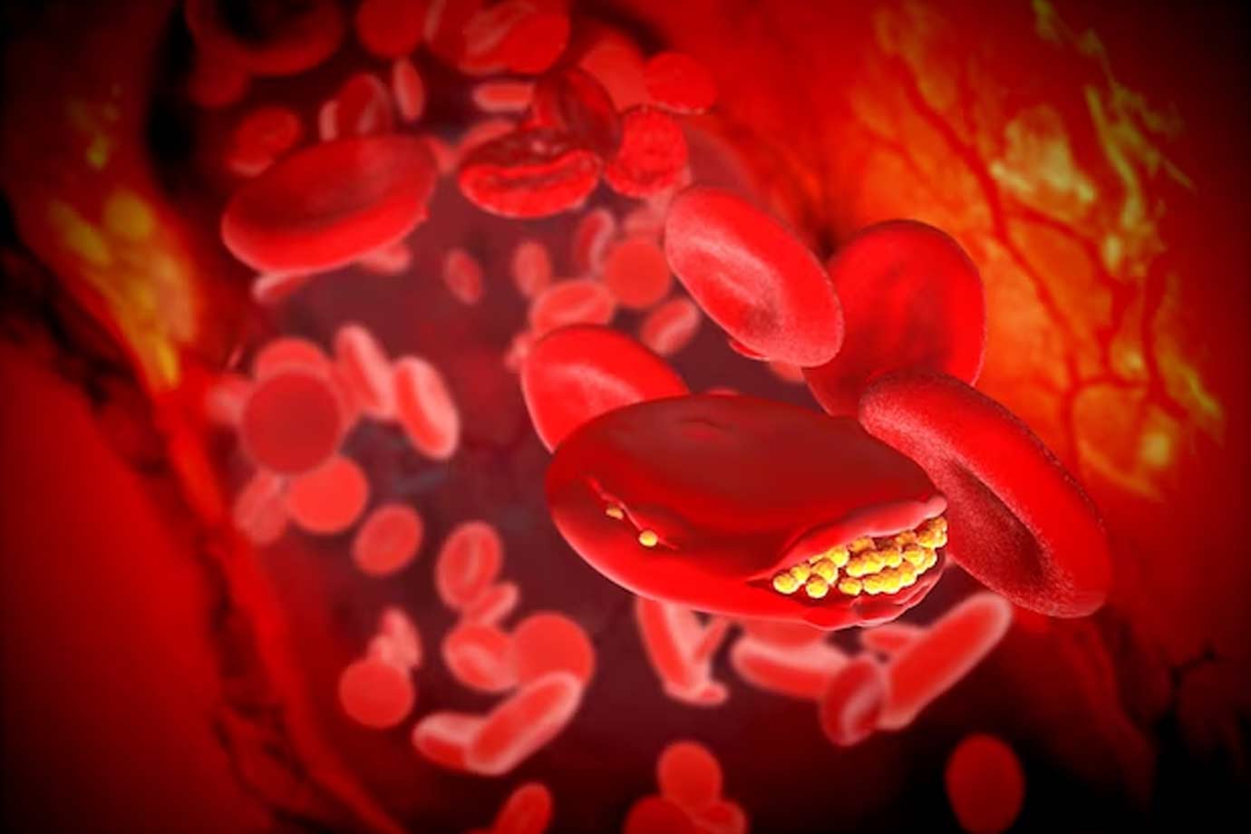 इस तरह से करेंगे लहसुन का सेवन तो हाई कोलेस्ट्रॉल की हो जायेगी छुट्टी