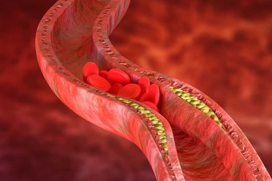 बैड कोलेस्‍ट्रॉल कम करने के लिए पिएं लहसुन वाला दूध garlic milk to