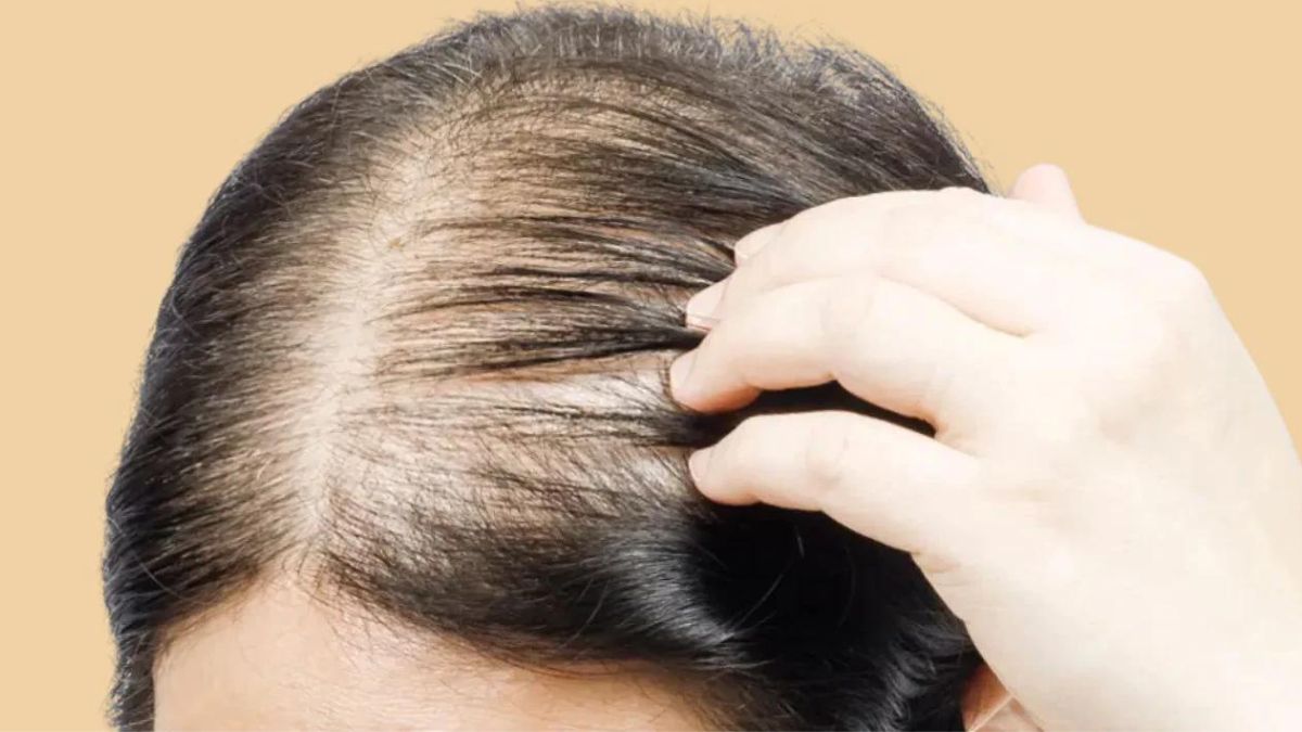 Balding Home Remedies : வழுக்கை விழாமல் இருக்க பெண்கள் என்ன செய்ய வேண்டும் தெரியுமா? 