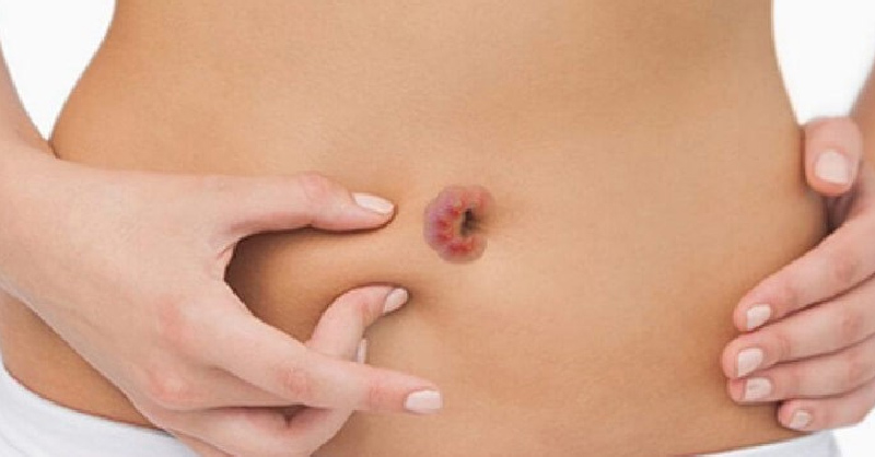 belly button infection symptoms