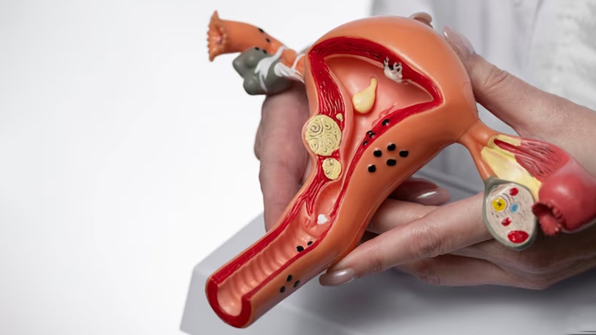 endometriosis may cause infertility
