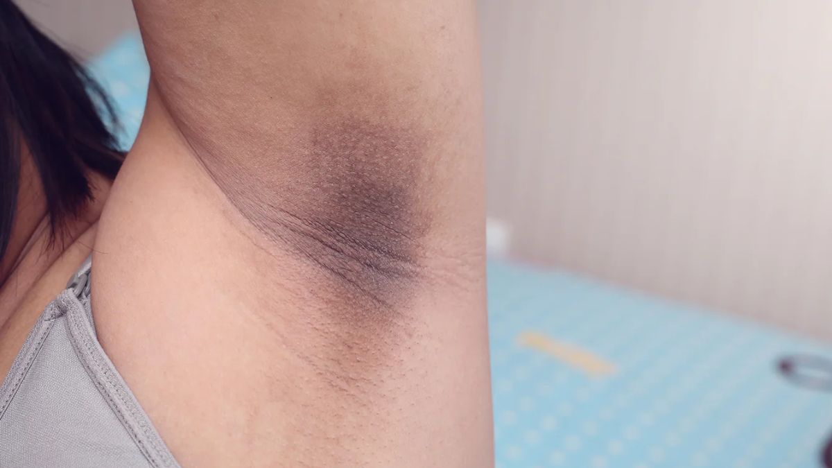 How to remove dark spots on armpits