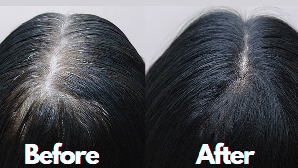 how to stop white hair problem