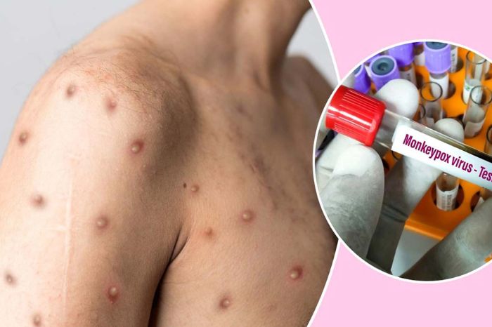mpox virus monkey pox virus spread how is pox virus monkey pox symptoms and prevention 