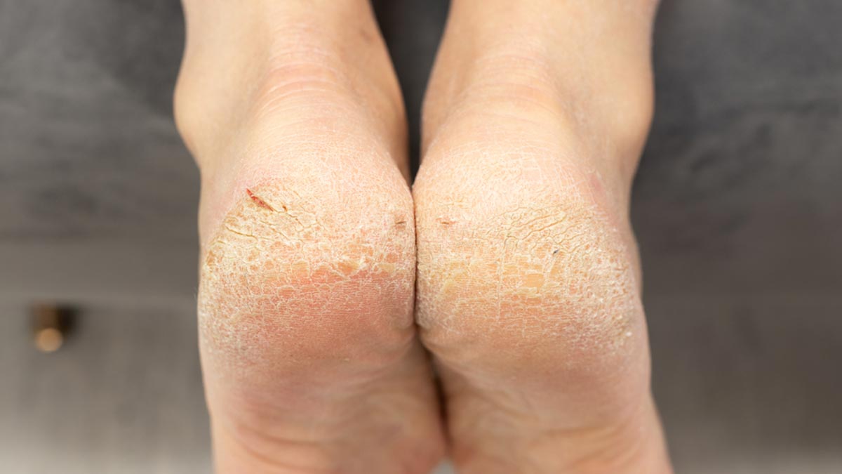 Cracked Heels? Don't Worry! Here's How To Treat Them