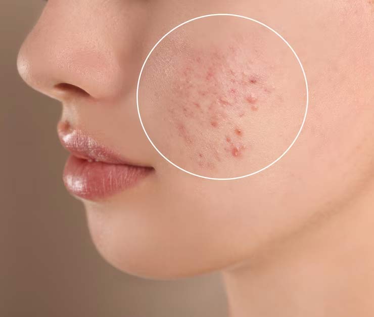 foods that cause pimples