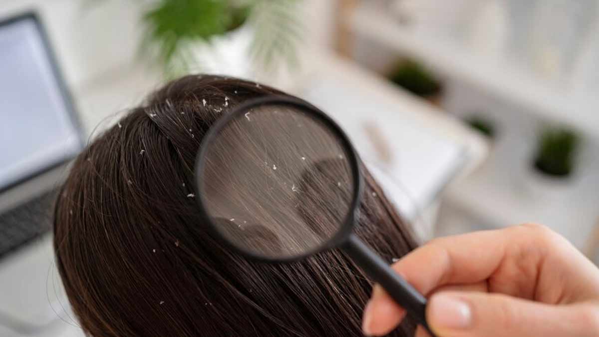 Dandruff Problem: डैंड्रफ के कारण बालों में दिख रहा है सफेद पाउडर जैसा कुछ, तो अपनाएं यह हेयर केयर रूटीन 