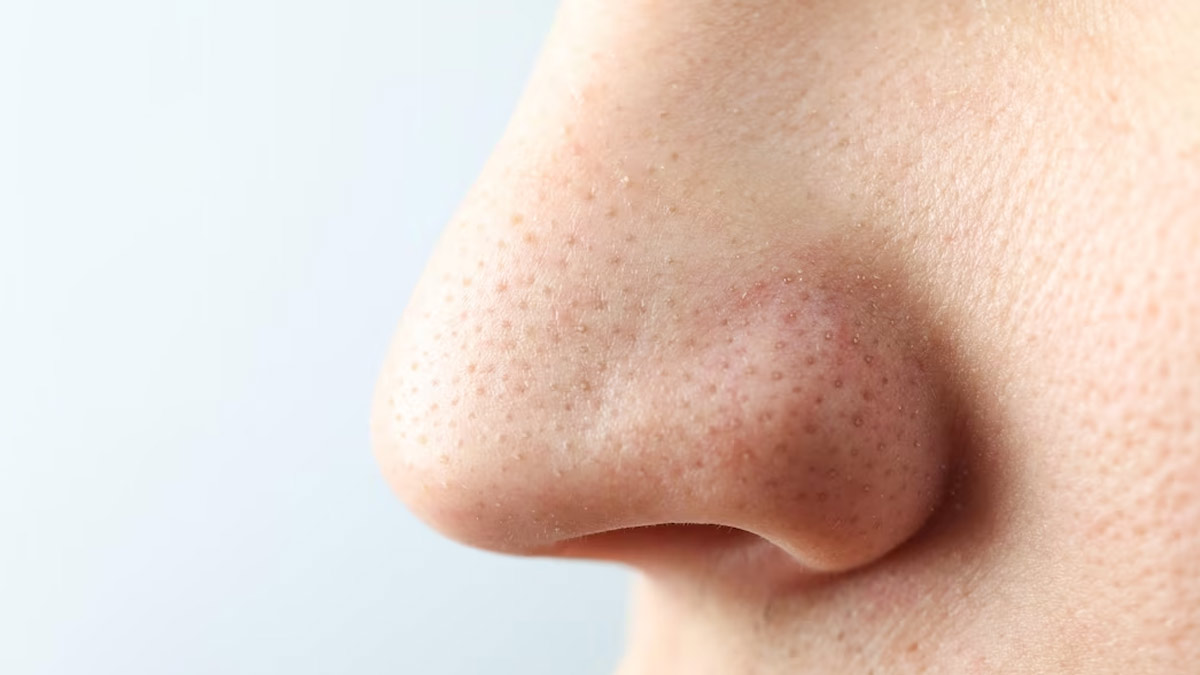 nose blackheads