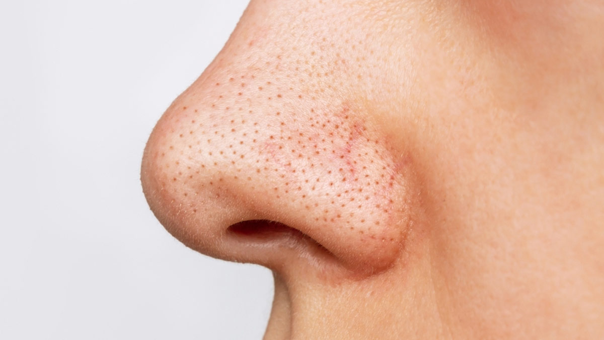 Nose Blackheads Treatment: नाक पर मौजूद जिद्दी ब्लैकहेड्स होंगे गायब