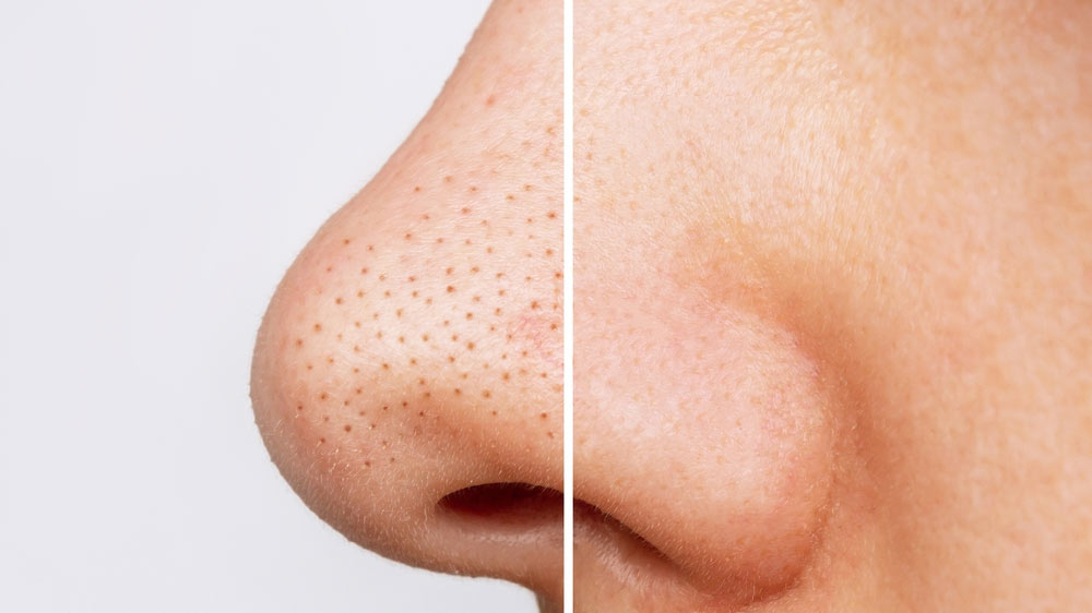 Blackheads Removal Treatment at home