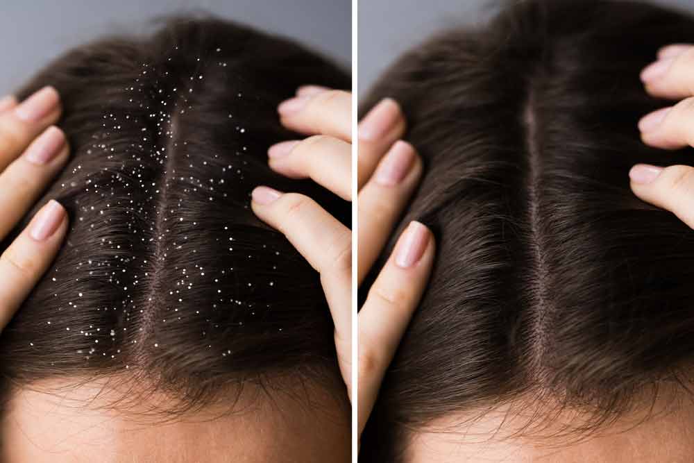dandruff treatment at home