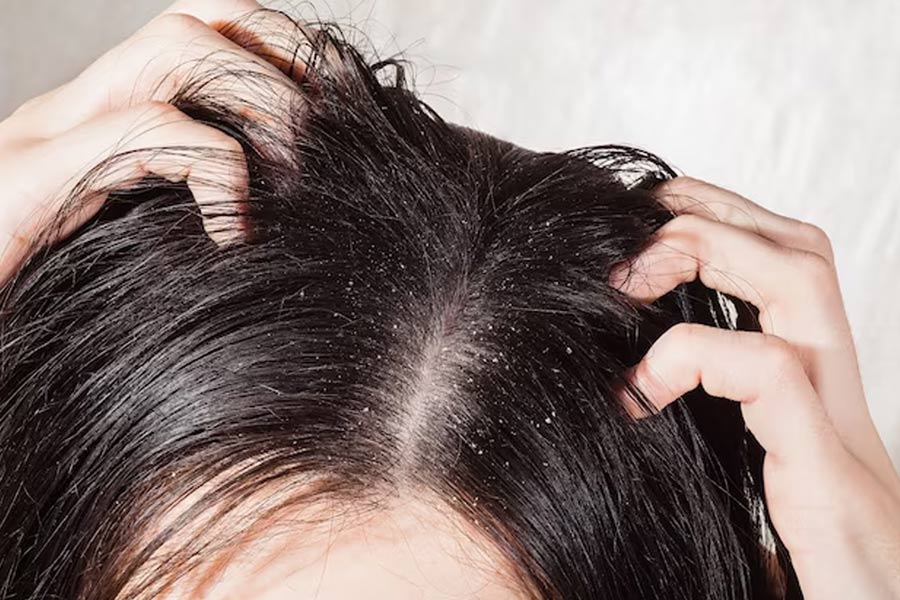 dry scalp and hair