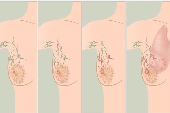 types of breast cancer