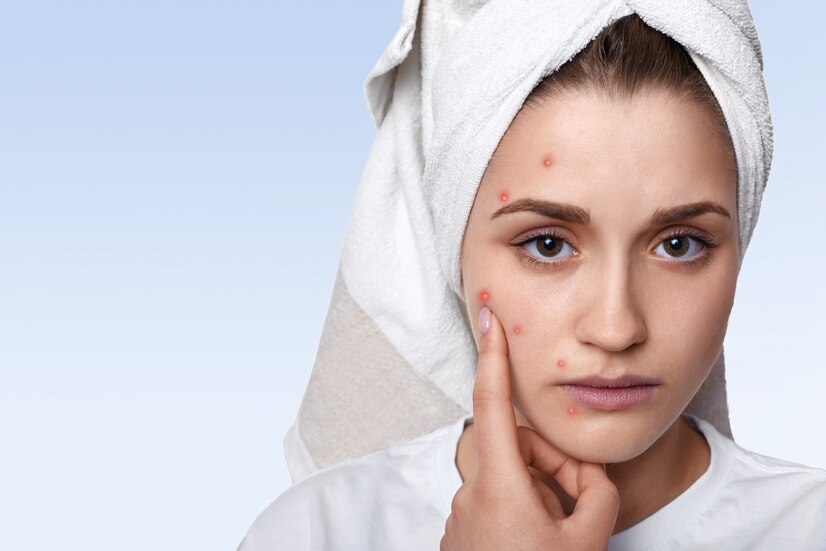 acne and hormonal imbalance