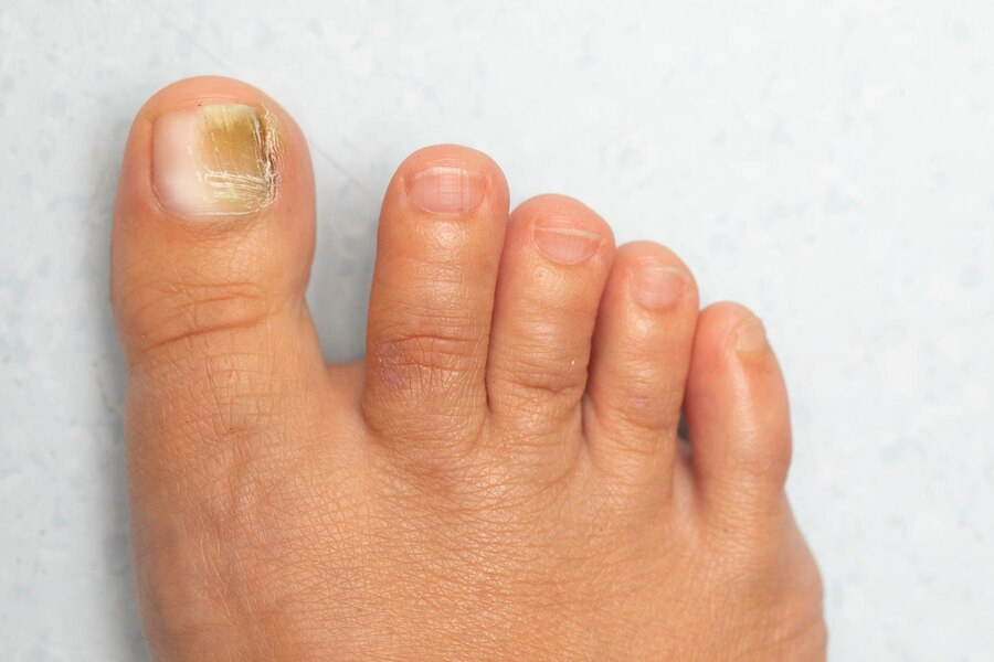 foot fungal infection