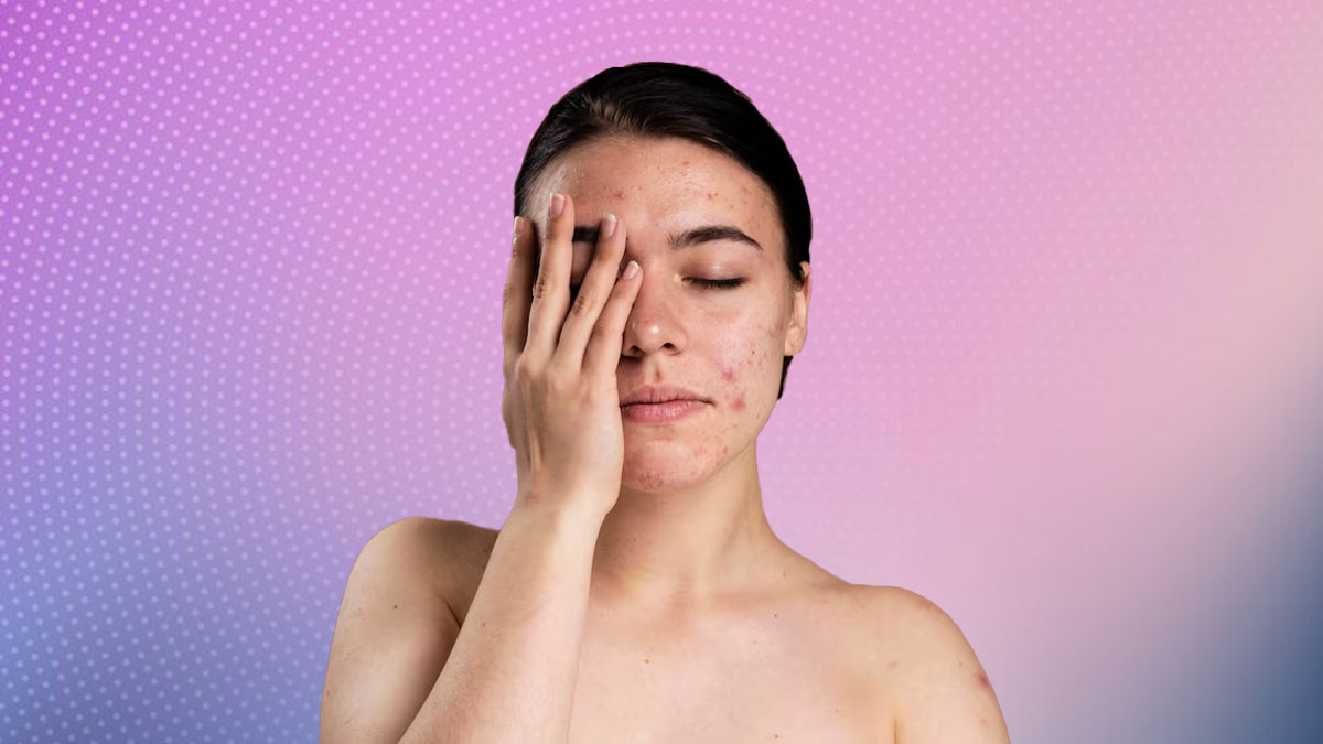 boils and pimples at home