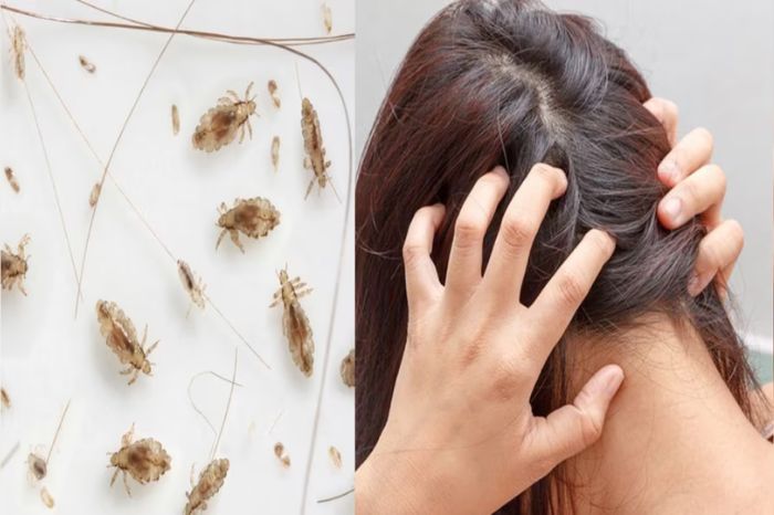 clove oil for head lice treatment 