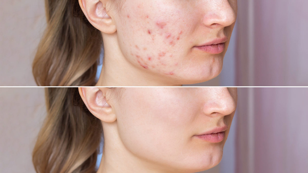 effective home remedies for breakouts on face new pic