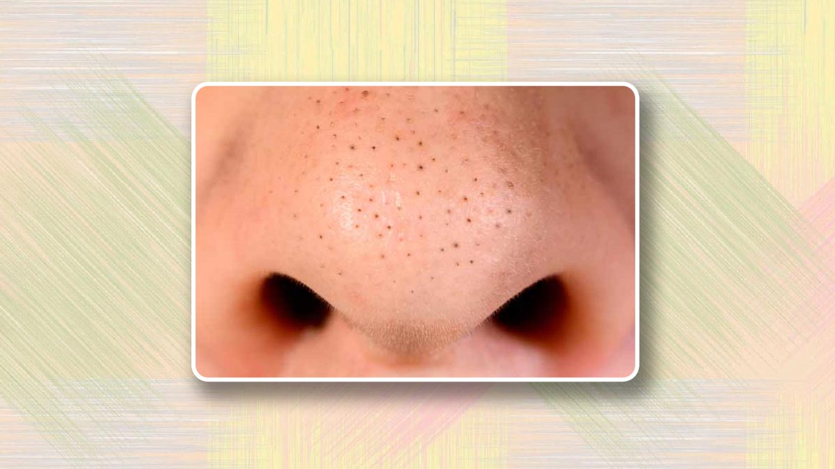 Besan For Blackheads: बेसन हटाएगा नाक के ब्लैकहेड्स, पहली ही बार में ...