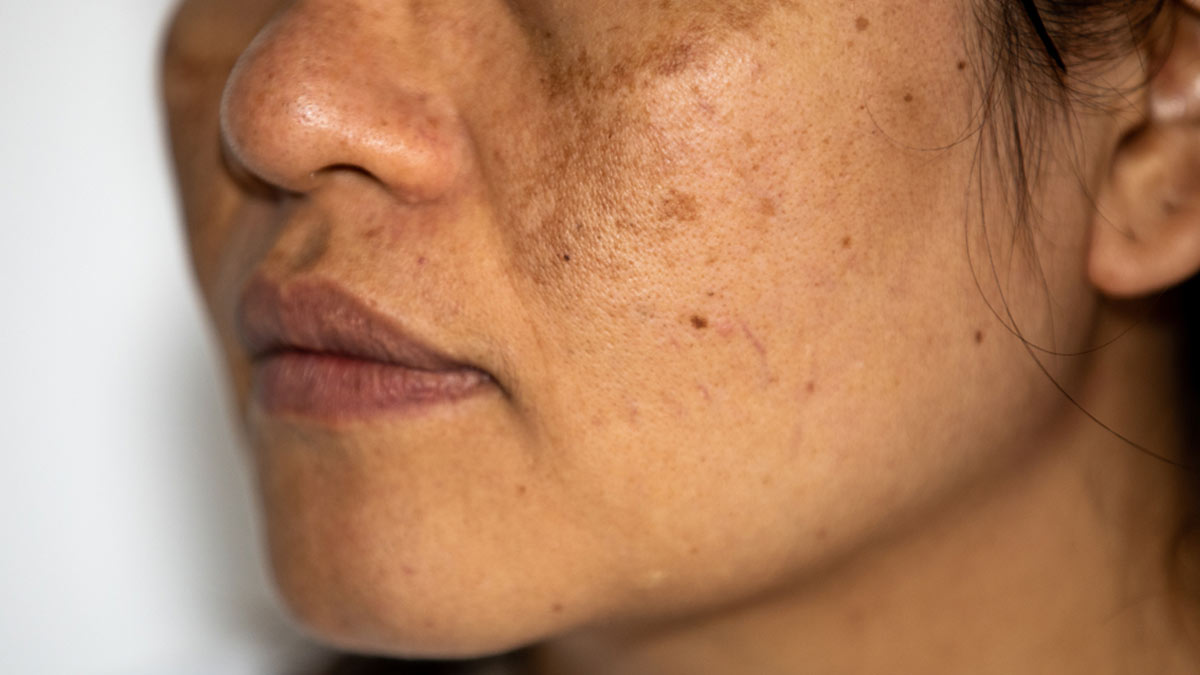 tips to reduce pigmentation on cheeks