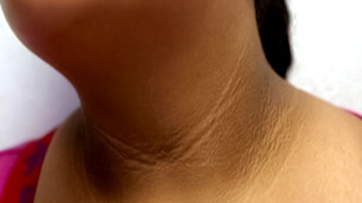 How do I stop pigmentation on my neck pic