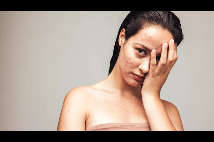 causes of treatment and prevention steps for adult acne 