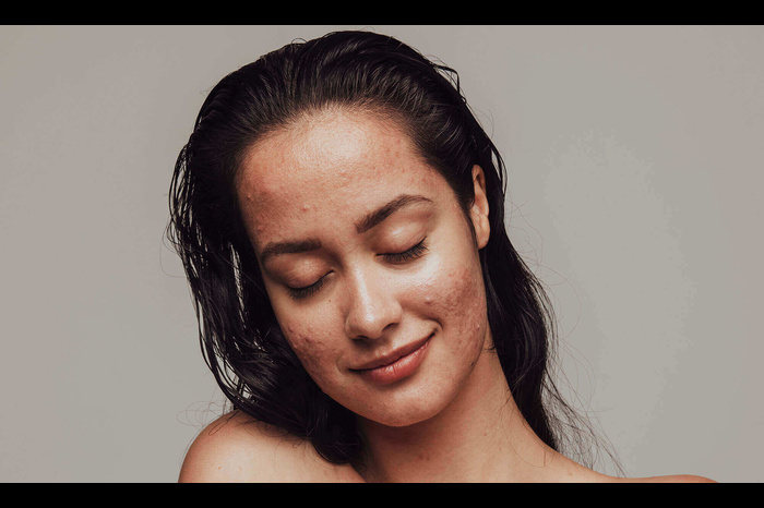 causes of treatment and prevention steps for adult acne