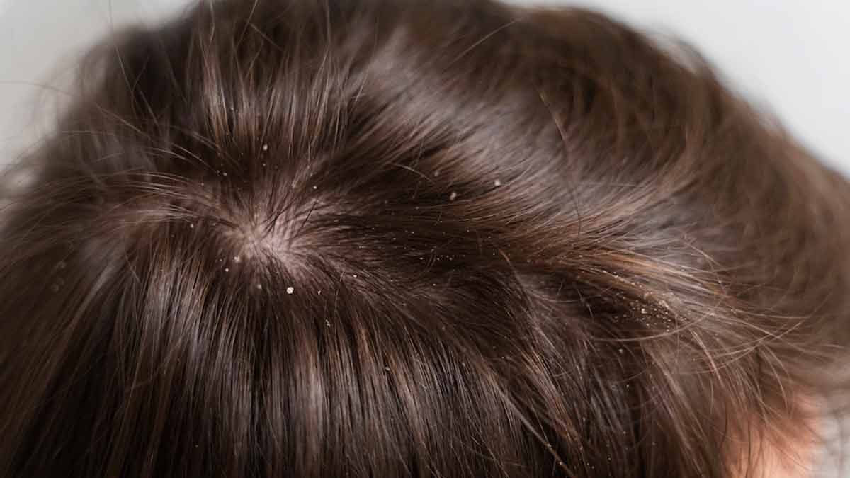 hair fall and white hair