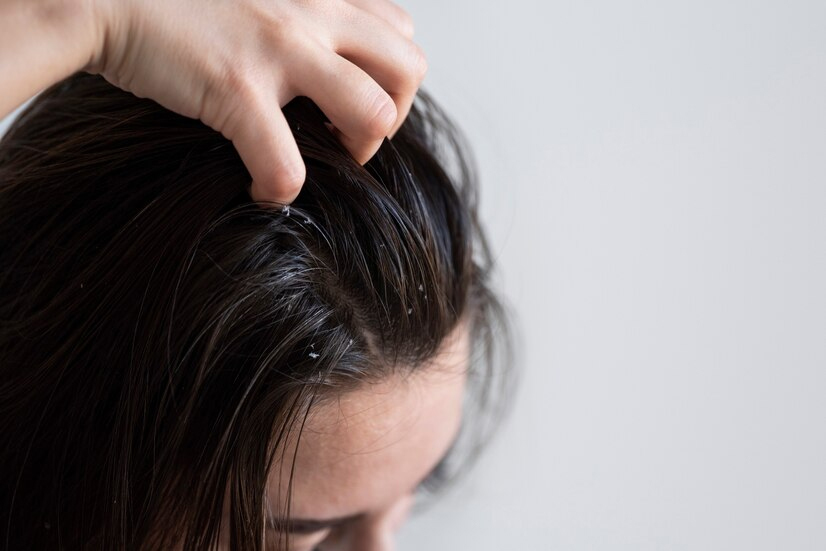 tips for remove dandruff